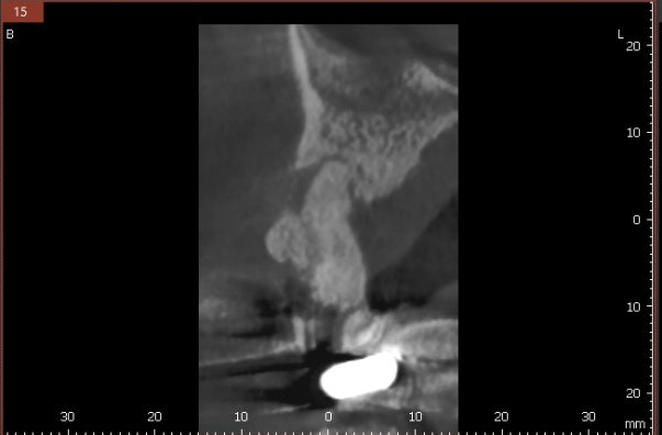 골소실을 확인하는 CBCT 단면 영상