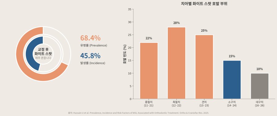 교정 치료 환자의 화이트 스팟 유병률 — 2025년 메타분석