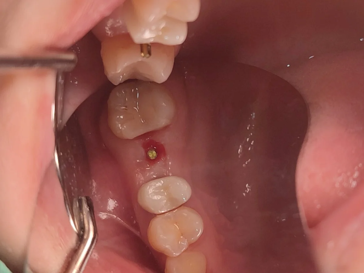 무절개 임플란트 가이드핀 — 절개 없이 방향 확인