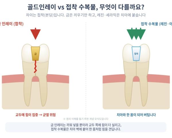 골드인레이 대신 접착 수복물을 권하는 이유