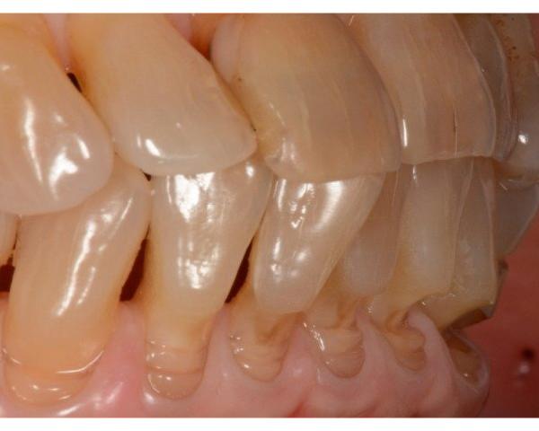 양치할 때만 시린 치아, 충치가 아닐 수도 있습니다 — 치경부 V자 패임(NCCL) — 광주 수완지구 치과