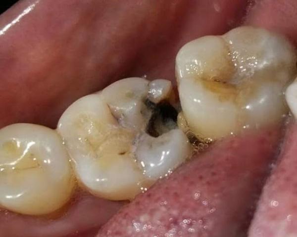 양치를 잘하는데도 어금니에 충치가 생긴다면 — 아이 치아 홈 메우기(실란트) — 광주 수완지구 치과