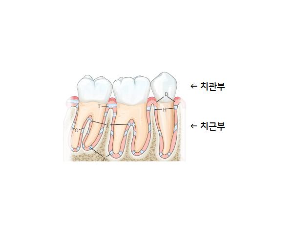크라운이 흔들려요 — 다시 붙이면 될까요, 원인 세 가지 — 광주 수완지구 치과